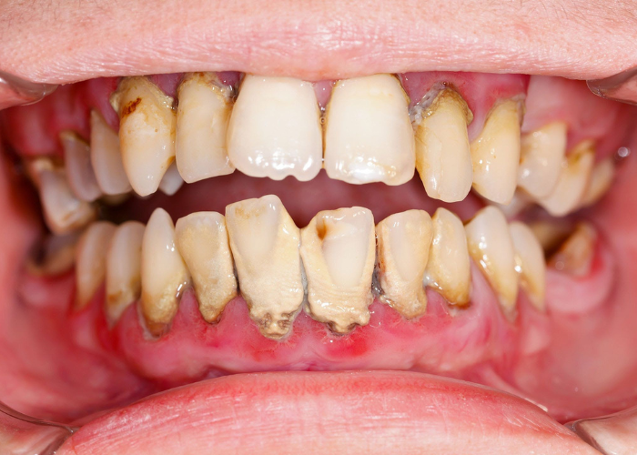 Bao lâu lấy cao răng 1 lần? Tác dụng của lấy cao răng?