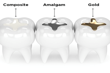 Bật mí: Hàn răng được bao lâu? Tuổi thọ bao nhiêu năm