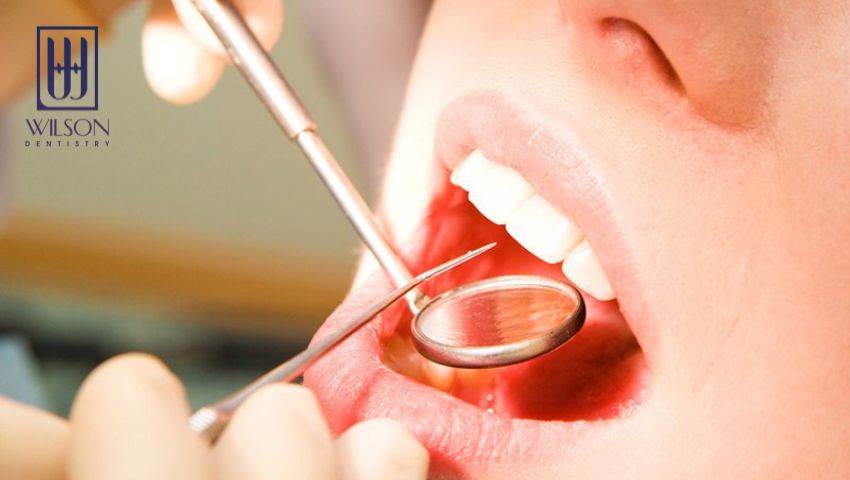 cach-lay-cao-rang-tai-nha-khoa-wilson-co-gi-dac-biet-3