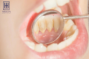 Có nên lấy cao răng? Lấy cao răng bao nhiêu tiền?