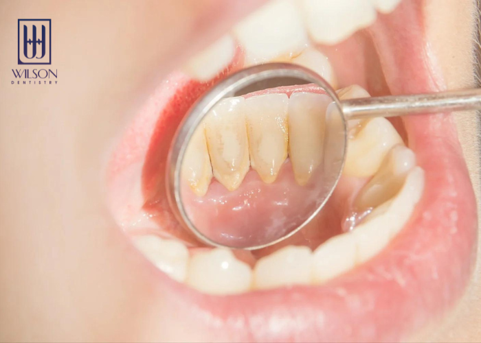 Có nên lấy cao răng? Lấy cao răng bao nhiêu tiền?