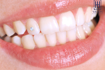 Gắn đá răng là gì? Những lưu ý khi thực hiện