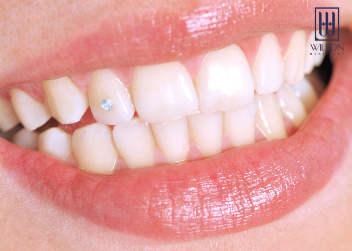 Gắn đá răng là gì? Những lưu ý khi thực hiện