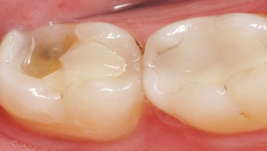 giai-dap-co-nen-han-rang-bang-composite-khong-1