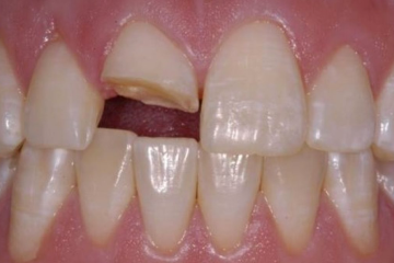 Hàn răng cửa giá bao nhiêu? Trường hợp nào có thể hàn răng cửa?