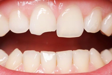 Hàn răng mẻ có đau không? Hàn răng mẻ giá bao nhiêu