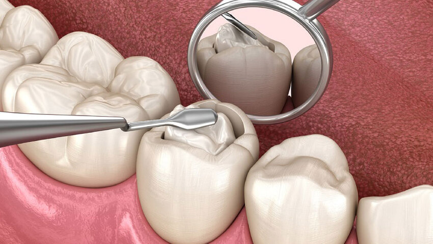 han-rang-sau-co-anh-huong-gi-khong-nhung-truong-hop-rang-sau-nen-han-1