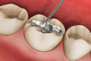 Hàn răng sâu có ảnh hưởng gì không? Những trường hợp răng sâu nên hàn