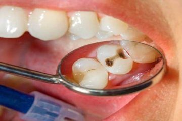 Hàn răng sâu có đau không? Các trường hợp nên hàn răng sâu