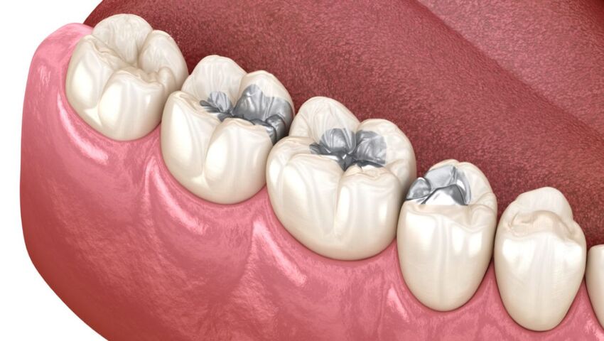 han-rang-sau-gia-bao-nhieu-nhung-yeu-to-anh-huong-toi-gia-han-rang-1