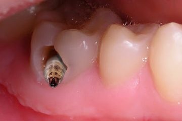 Hàn răng sâu giá bao nhiêu? Những yếu tố ảnh hưởng tới giá hàn răng