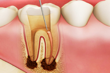Hàn tủy răng có tốt không? Có được vĩnh viễn không?