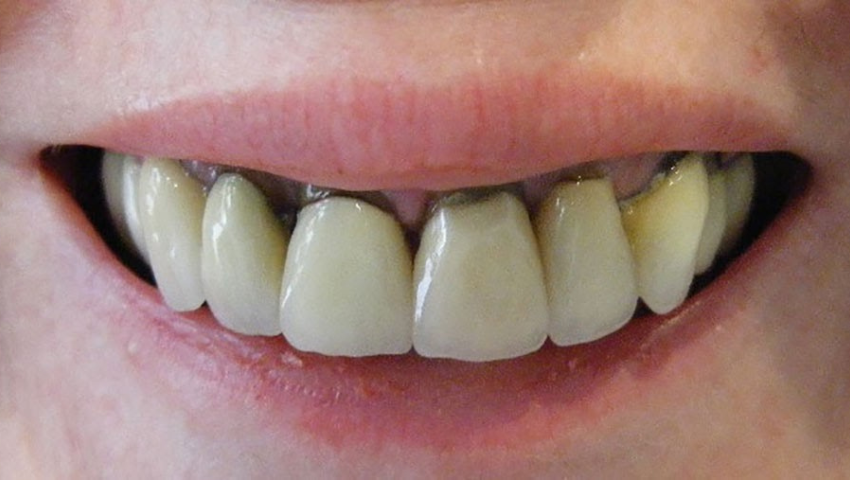 huong-dan-cach-lay-cao-rang-den-tai-nha-1