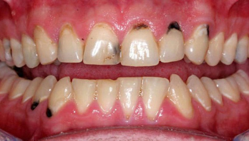 huong-dan-cach-lay-cao-rang-den-tai-nha-2