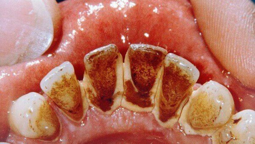 huong-dan-cach-lay-cao-rang-den-tai-nha-3