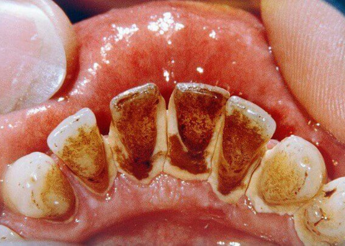 Hướng dẫn cách lấy cao răng đen tại nhà