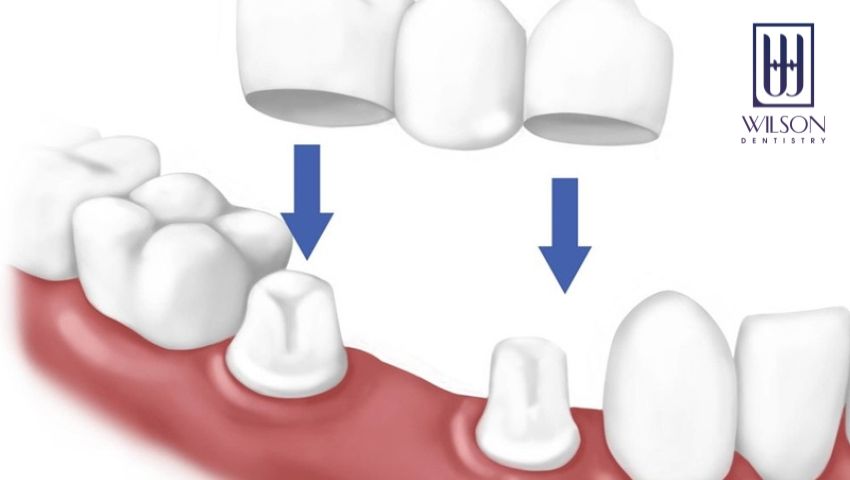 lam-cau-rang-su-co-tot-hay-khong-su-dung-duoc-bao-lau-2