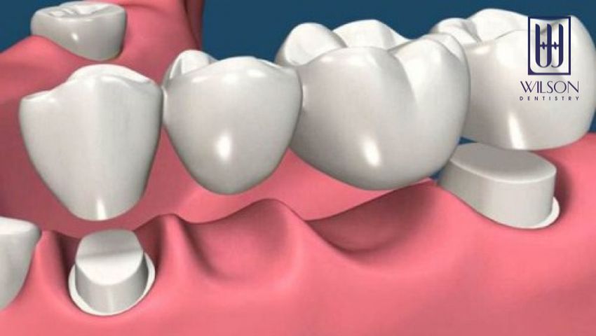 lam-cau-rang-su-co-tot-hay-khong-su-dung-duoc-bao-lau-3