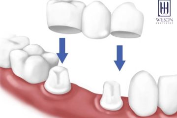 Làm cầu răng sứ có tốt hay không? Sử dụng được bao lâu?