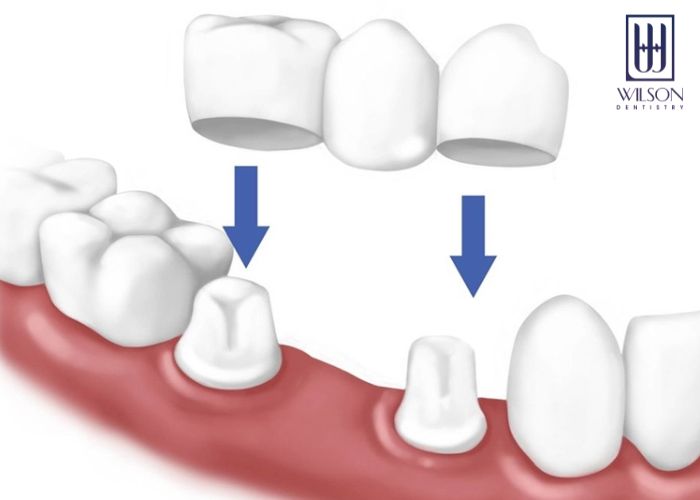 Làm cầu răng sứ có tốt hay không? Sử dụng được bao lâu?