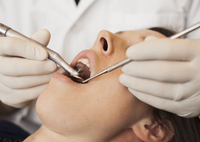 Lấy cao răng mất bao lâu? Có đau hay không?