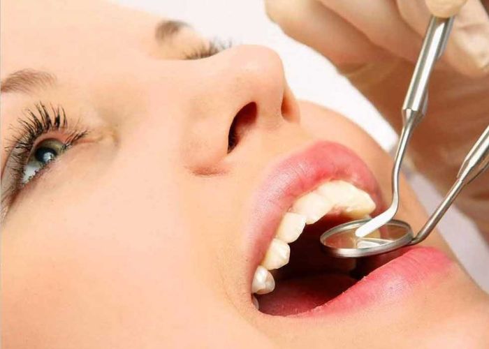 Làm cao răng xong kiêng gì để răng chắc khỏe?