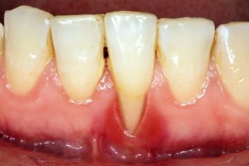 Nguyên nhân gây ra tình trạng lấy cao răng bị hở chân răng