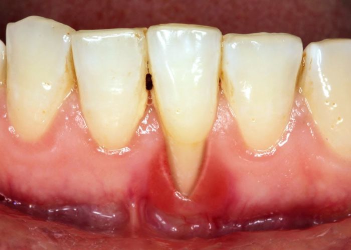 Nguyên nhân gây ra tình trạng lấy cao răng bị hở chân răng