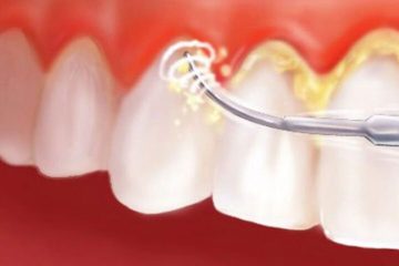 Quy trình hàn cổ răng an toàn tại hệ thống Nha khoa Wilson