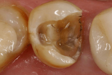 Răng bị vỡ có hàn được không? Cách phòng tránh răng bị vỡ