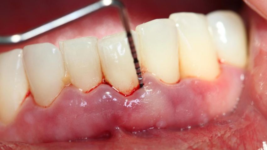 tai-sao-lay-cao-rang-xong-bi-chay-mau-lien-tuc-3