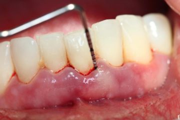 Tại sao lấy cao răng xong bị chảy máu liên tục?