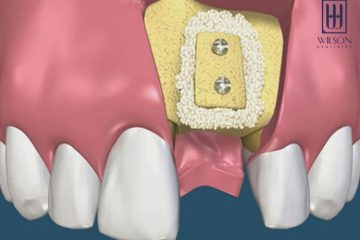 Tại sao phải ghép xương răng trong trồng răng Implant?