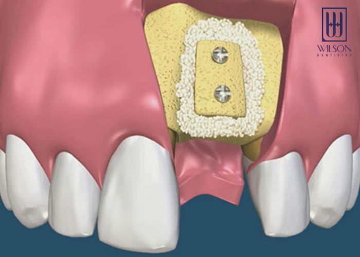 Tại sao phải ghép xương răng trong trồng răng Implant?
