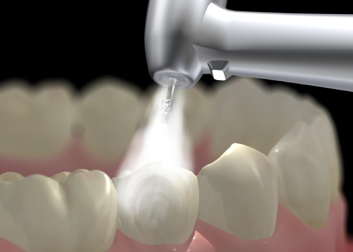 Tìm hiểu quy trình lấy cao răng bằng máy siêu âm