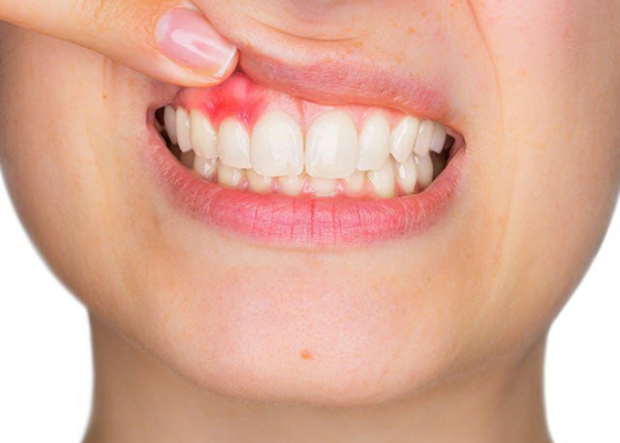 Bệnh viêm lợi là gì? Những nhóm thuốc điều trị viêm lợi hiệu quả