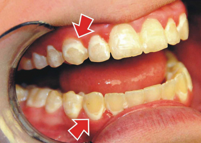Bệnh viêm nha chu là gì? Thuốc điều trị viêm nha chu