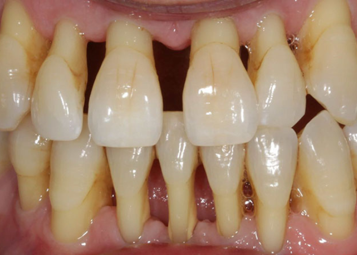 Bỏ túi những cách điều trị viêm nha chu tại nhà