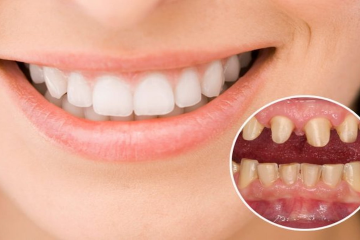 Bọc răng sứ có tẩy trắng được không?