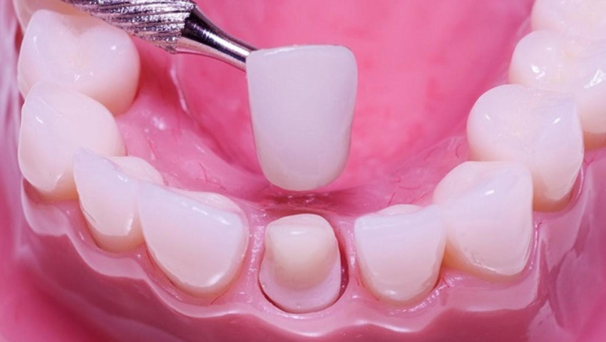 boc-rang-su-co-tay-trang-duoc-khong