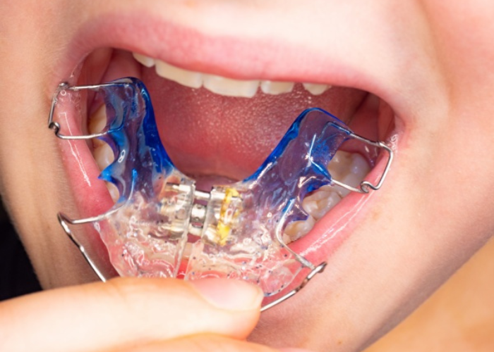 Các loại khí cụ nong hàm phổ biến? Tác dụng của từng loại