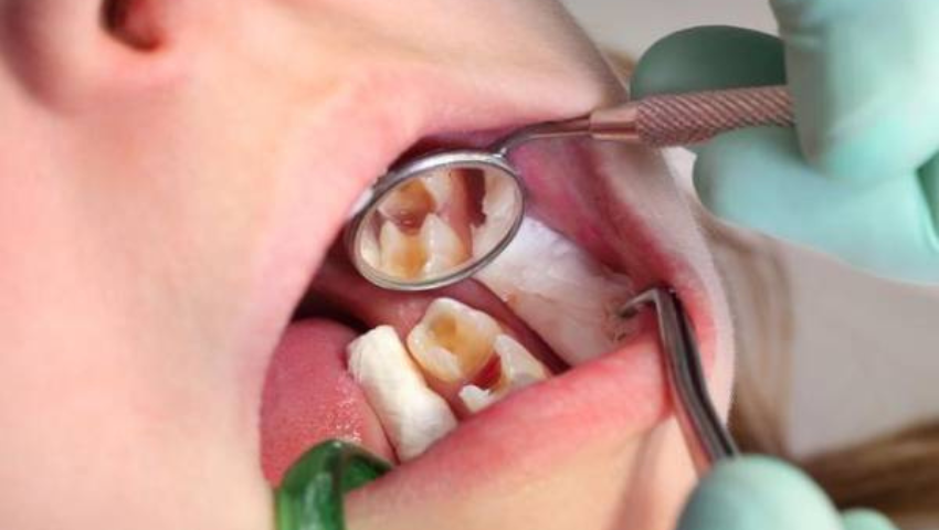 cac-loai-thuoc-khang-sinh-dieu-tri-viem-tuy-rang-3