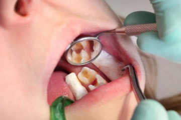 Các loại thuốc kháng sinh điều trị viêm tủy răng