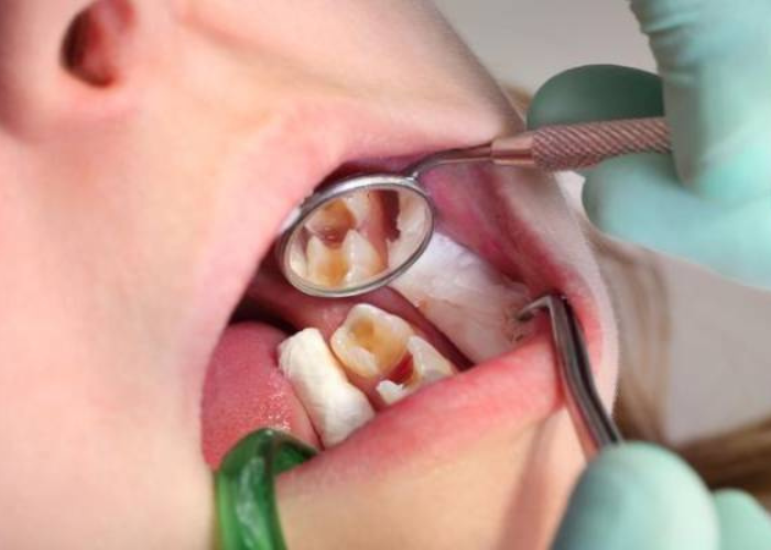 Các loại thuốc kháng sinh điều trị viêm tủy răng