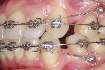 Cắm vít niềng răng có đau không?