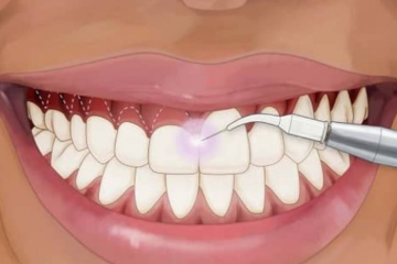 Cắt lợi có nguy hiểm không? Cắt lợi có mọc lại không?