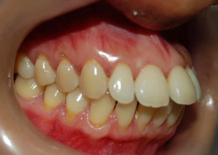 Cắt lợi hàm hô có nguy hiểm không?