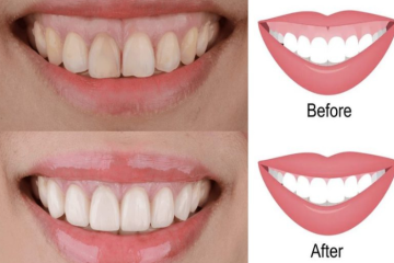 Cắt lợi thẩm mỹ có đau không? Những lưu ý sau khi cắt lợi