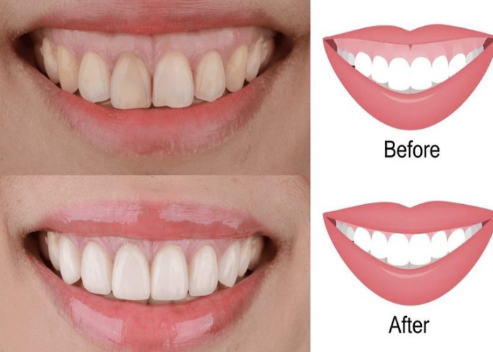 Cắt lợi thẩm mỹ có đau không? Những lưu ý sau khi cắt lợi