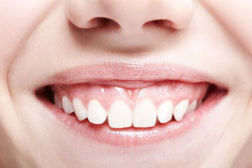 Chi phí cắt lợi giá bao nhiêu tiền? Yếu tố ảnh hưởng chi phí?